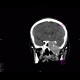 Osteolytic changes of facial skeleton: CT - Computed tomography
