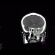 Osteolytic changes of facial skeleton: CT - Computed tomography