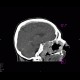 Osteolytic changes of facial skeleton: CT - Computed tomography