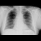 Osteolytic lesion of the rib: X-ray - Plain radiograph