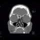 Osteoma of lamina papyracea: CT - Computed tomography