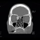 Osteoma of lamina papyracea: CT - Computed tomography