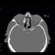 Osteoma of lamina papyracea: CT - Computed tomography