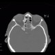 Osteoma of lamina papyracea: CT - Computed tomography