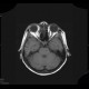 Osteoma of lamina papyracea: MRI - Magnetic Resonance Imaging