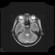 Osteoma of lamina papyracea: MRI - Magnetic Resonance Imaging