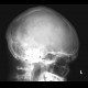 Osteoma of frontal sinus: X-ray - Plain radiograph