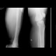 Chronic osteomyelitis and bone squestration: X-ray - Plain radiograph