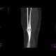 Chronic osteomyelitis and bone squestration: CT - Computed tomography