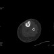 Chronic osteomyelitis and bone squestration: CT - Computed tomography