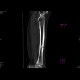 Chronic osteomyelitis and bone squestration: CT - Computed tomography
