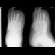 Acute osteomyelitis of the foot: X-ray - Plain radiograph