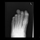 Osteomyelitis of toe: X-ray - Plain radiograph