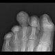 Osteomyelitis of toe: X-ray - Plain radiograph