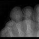 Osteomyelitis of toe: X-ray - Plain radiograph