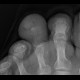 Osteomyelitis of toe: X-ray - Plain radiograph