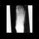 Osteomyelitis of fifth metatarsal bone: X-ray - Plain radiograph