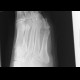 Osteomyelitis of fifth metatarsal bone: X-ray - Plain radiograph