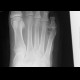 Osteomyelitis of fifth metatarsal bone: X-ray - Plain radiograph