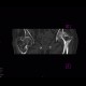 Osteonecrosis of femoral head, osteoarthrosis: CT - Computed tomography
