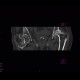 Osteonecrosis of femoral head, osteoarthrosis: CT - Computed tomography