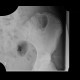 Osteopathia striata, systemic bone disorder: X-ray - Plain radiograph