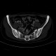 Osteopathia striata, systemic bone disorder: CT - Computed tomography