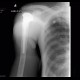 Osteoplastic changes of bone: X-ray - Plain radiograph