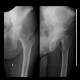 Osteosarcoma of pelvis, bone tumour: X-ray - Plain radiograph