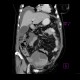 _fetch_thumbnail.php?img=Ovarian%20carcinoma,%20carcinomatosis.CT.1_0001.JPG