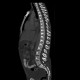 Unknown pathology of spine: CT - Computed tomography