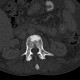 Unknown pathology of spine: CT - Computed tomography