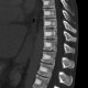 Unknown pathology of spine: CT - Computed tomography