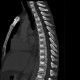 Unknown pathology of spine: CT - Computed tomography