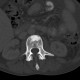 Unknown pathology of spine: CT - Computed tomography