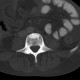 Unknown pathology of spine: CT - Computed tomography