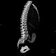 Unknown pathology of spine: CT - Computed tomography