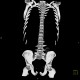 Unknown pathology of spine: CT - Computed tomography