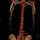 Unknown pathology of spine: CT - Computed tomography