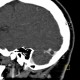 Pacchioni granulation in transverse sinus: CT - Computed tomography