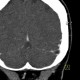 Pacchioni granulation in transverse sinus: CT - Computed tomography