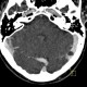 Pacchioni granulation in transverse sinus: CT - Computed tomography