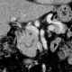 Pancreas divisum on CT, mininum intensity projection, MinIP: CT - Computed tomography