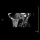 Pancolitis, colitis, severe: CT - Computed tomography