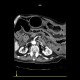 Pancolitis, colitis, severe: CT - Computed tomography