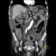 Pancolitis, colitis, severe: CT - Computed tomography