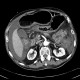 Pancolitis, colitis, severe: CT - Computed tomography