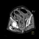 Pancolitis, colitis, severe: CT - Computed tomography