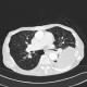 Loculated pleural fluid, aneurysm of left ventricle, apical and thrombosed: CT - Computed tomography