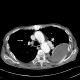 Loculated pleural fluid, aneurysm of left ventricle, apical and thrombosed: CT - Computed tomography